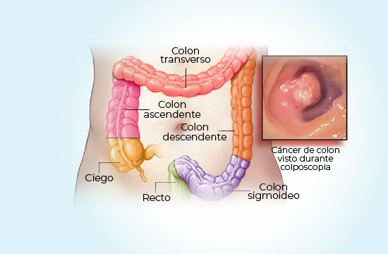 cáncer de colon detección temprana