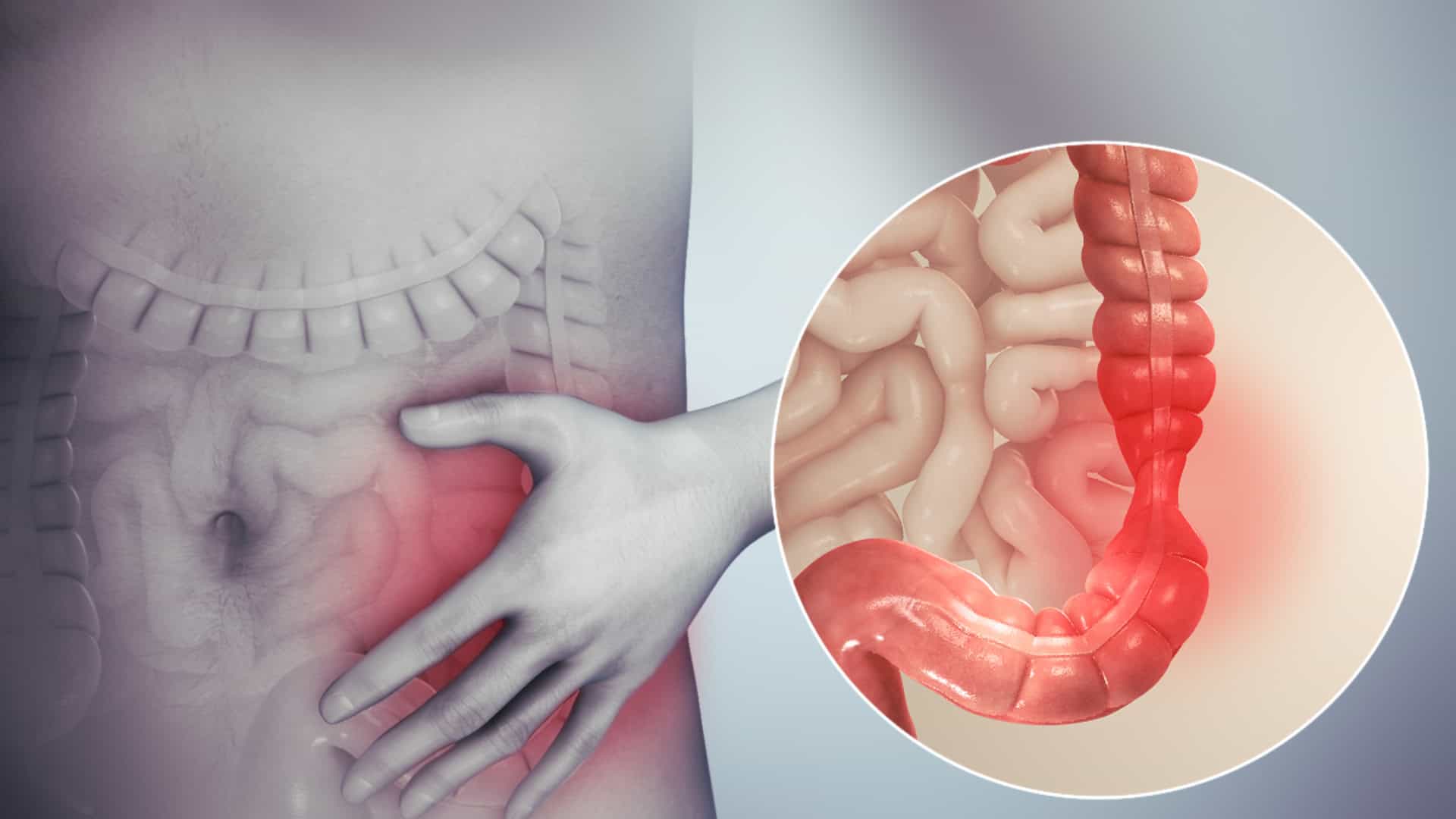 Síndrome intestino delgado Málaga
