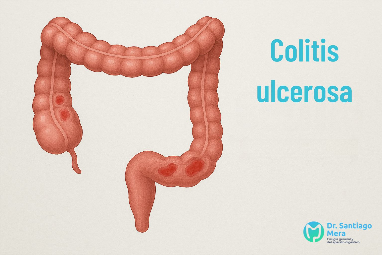colitis ulcerosa cirujano Málaga