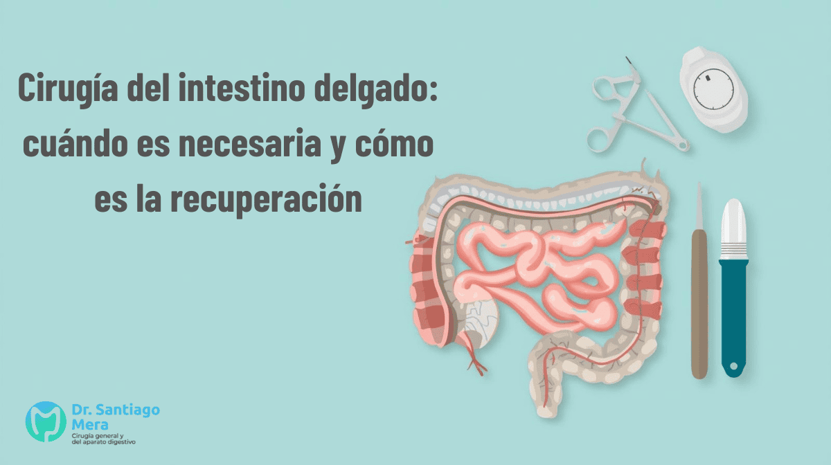 Cirugía del intestino delgado cuándo es necesaria y cómo es la recuperación Málaga