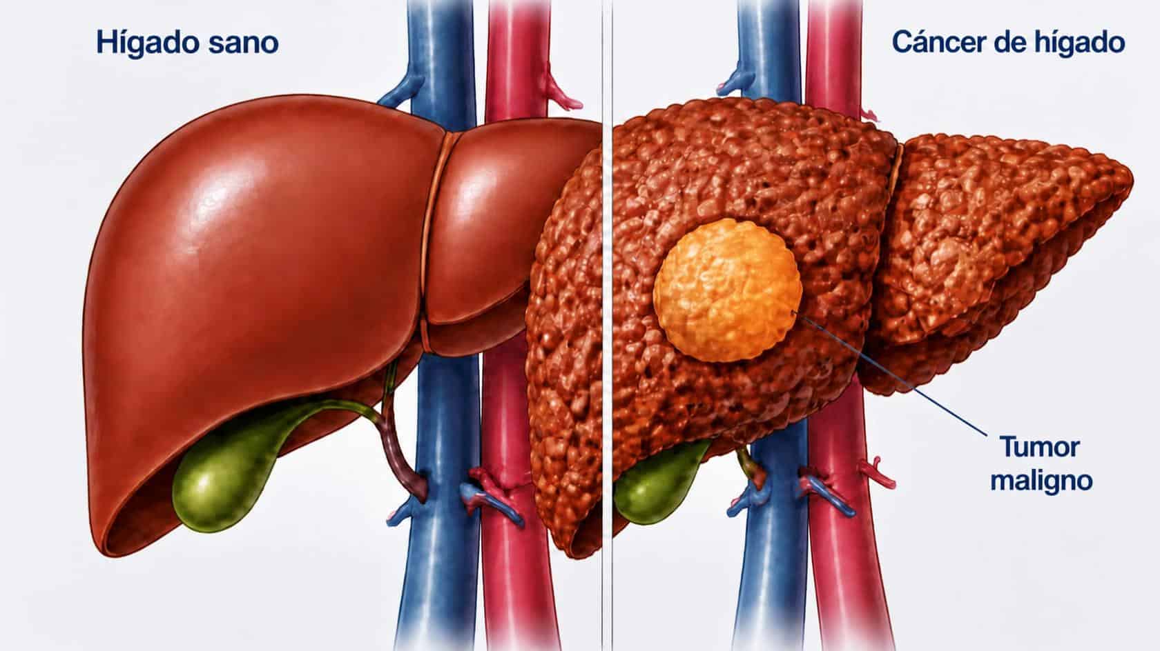 tratamiento cáncer hígado en Málaga