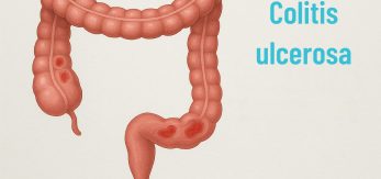 colitis ulcerosa cirujano Málaga