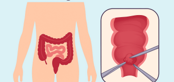 Ilustración de cirugía rectal