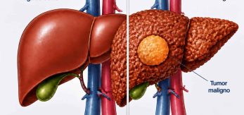 tratamiento cáncer hígado en Málaga